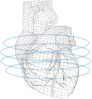 CT Coronary Angiogram