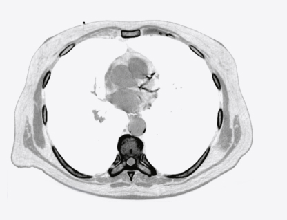 Hard (calcified) plaque