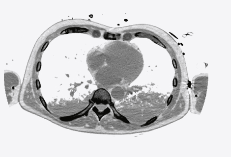 Arterial narrowing